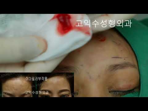 forehead filler complication