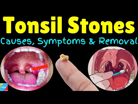 Tonsil Stones (Tonsilloliths): Symptoms, Causes, Removal, Treatment & Prevention