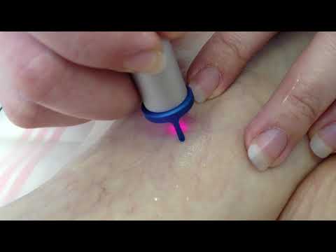 Laser Treatment of Vascular Lesion with MedArt VariMed System