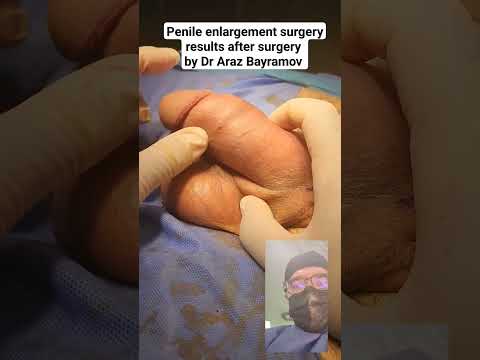 Penile enlargement surgery results after surgery by Dr Araz Bayramov #andrologist #urologist #draraz