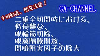 閲覧注意！二重全切開の手術動画です。