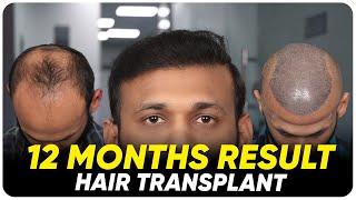 Hair Transplant in Hubli | Best Results & Cost of Hair Transplant in Hubli