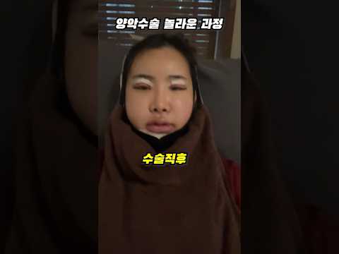 단연코 양악수술 레전드 #shorts