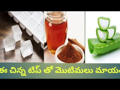 ఈ చిన్న టిప్ తో మీ మొటిమలను మాయం చేయండి||how to get a pimple clear face