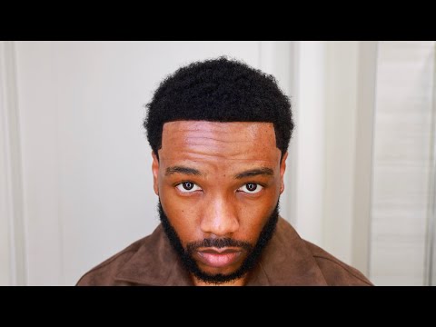 Hair Transplant Week 30