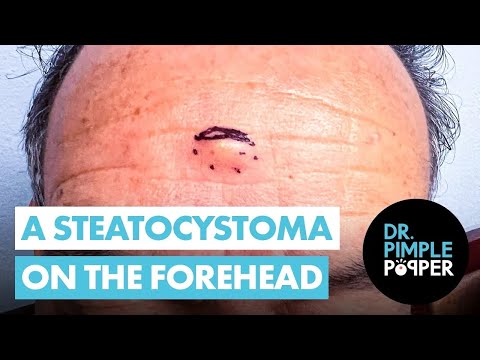 A Forehead Steatocystoma with a BONUS | Dr. Pimple Popper