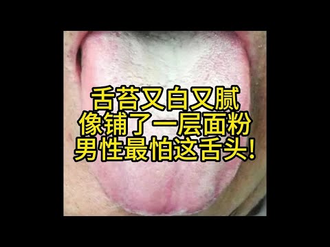 舌苔又白又腻 像铺了一层面粉 男性最怕这舌头!