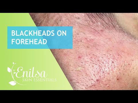 Blackheads on forehead