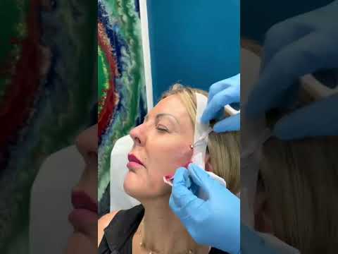 PDO Thread Lift Facelift by Dr. Dahabra in Florida | Non-Surgical Facelift Transformation #shorts