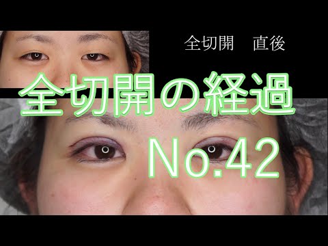 切開二重（全切開）42　モニター様の経過3か月目まで